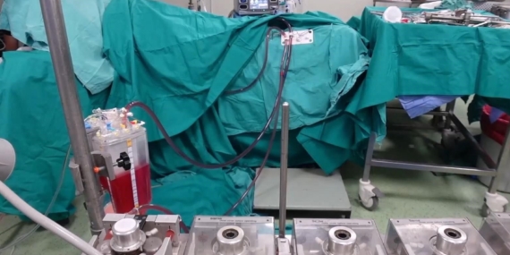 HIPEC ile Karın İçindeki Kanserlere Isı Tablalı Kemoterapi: Elazığ Fırat Üniversitesi Öncü Uygulama