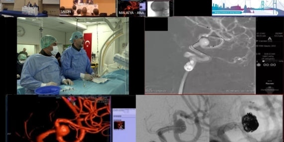 Kıtaları Birleştiren Cerrahi Başarı: Malatya’dan Uzman Ekipten Canlı Anjiyo ve Çifte Operasyon