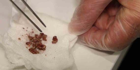 Elazığ’da Burun Estetiği Sirasında Rinolit Tespit Edildi: Uzman Açıklamasıyla Yeniden Değerlendirme